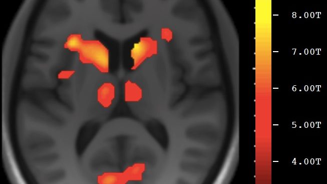 fMRI-bild av hjärna