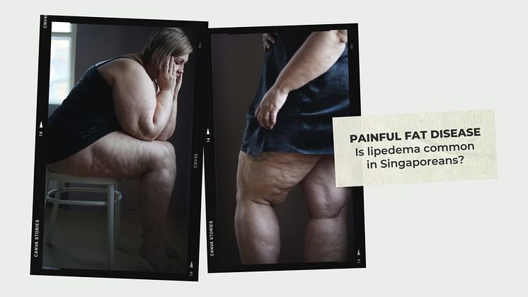 Is lipedema common in Singaporeans?