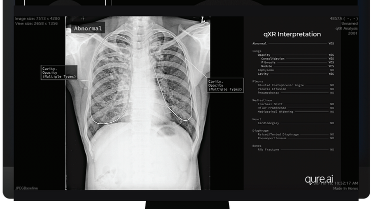 Qure.ai's CE-certified chest X-ray solution, qXR, will help identify which cases are clear of clinically relevant findings, allowing radiologists to detect them even before they open the case. 