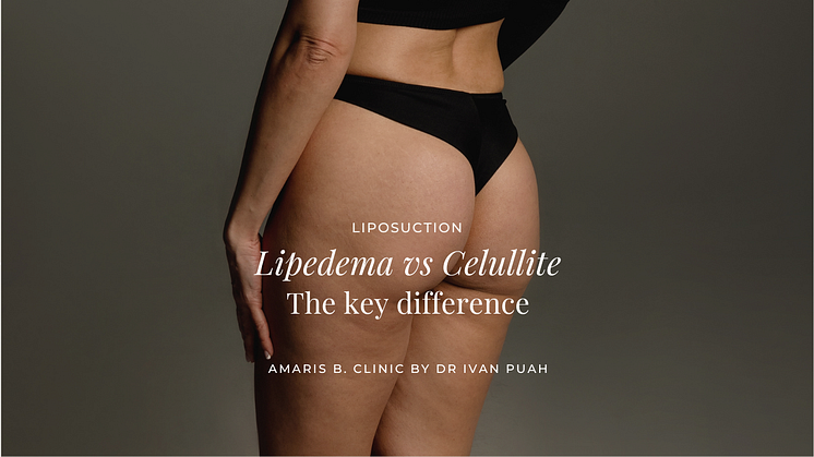 Lipedema vs Celullite