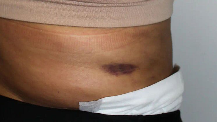 8 Things To Know About Botched Liposuction