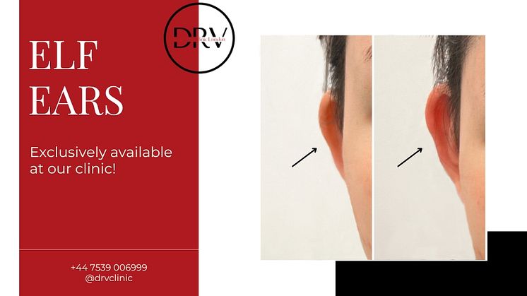 Introducing DRV Clinic's Revolutionary Non-Surgical Elf Ears Procedure: A Blend of Fantasy and Beauty