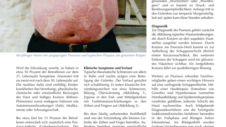 Psoriasis-Arthritis: Schuppenflechte und Gelenkentzündung