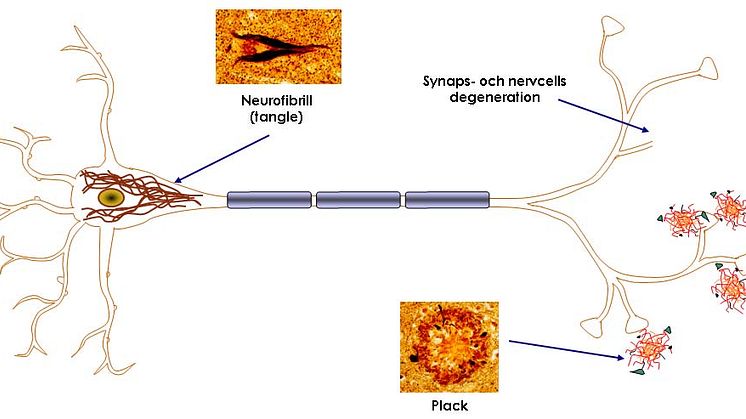 Laboratoriediagnostik vid Alzheimers sjukdom