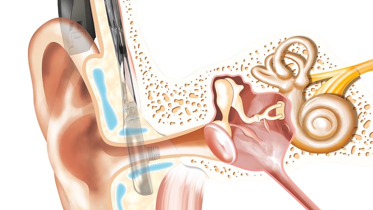 Schaubild - Cochlear™ Osia® System