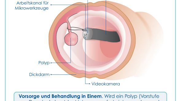 Darmkrebsvorsorge mittels Darmspiegelung