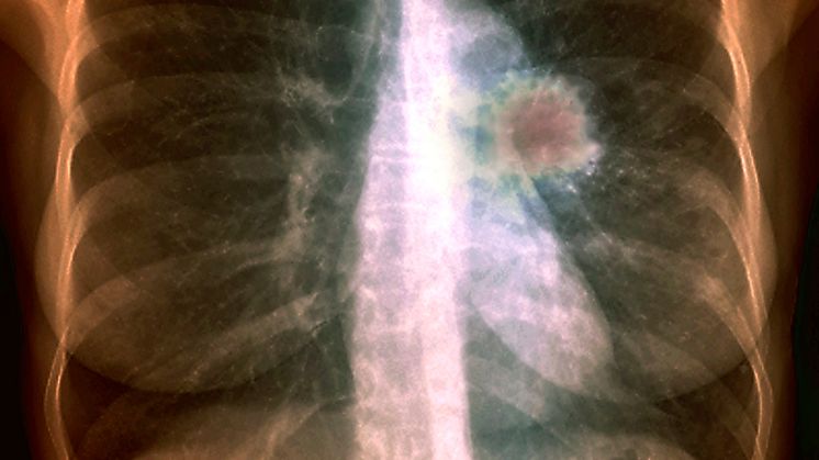 Nya data om larotrectinib bekräftar effekt och säkerhet för vuxna och barn med TRK fusionscancer, oavsett cancerform
