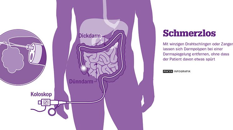 Darmspiegelung: Schmerzloses Entfernen von Polypen