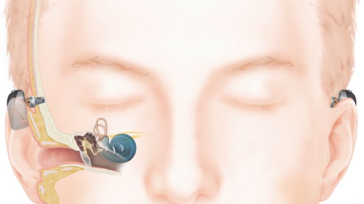 Wie das Hören mit einem Baha Knochenleitungsimplantat (Connect) funktioniert