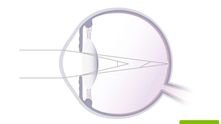 astigmatism_print