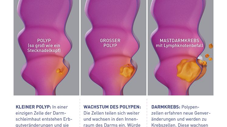 Grafische Darstellung des Wachstums vom Polyp zum Darmkrebs