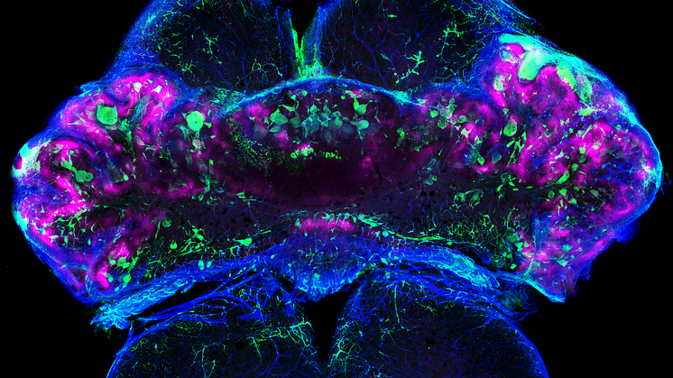 A brain from a mouse with CCM3 disease showing regions in the brain that lack oxygen (hypoxia, magenta) due to blood vessels (collagen IV, blue) that are occluded with coagulated blood (fibrin, green). Photo: Fabrizio Orsenigo/Maria Globisch
