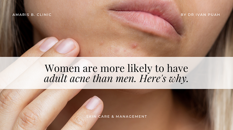 Women are more likely to have adult acne than men. Here's why