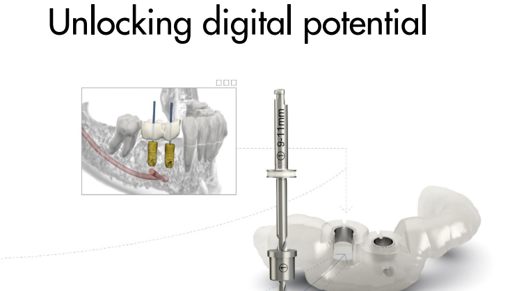 Unlocking digital potential - SIMPLANT with ASTRA TECH Implant System EV