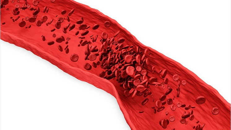 blood clot