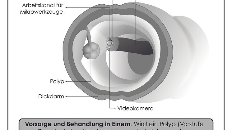 Nur bei der Darmspiegelung können Vorstufen von Darmkrebs entdeckt und gleich entfernt werden. 