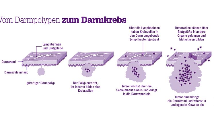 Vom Polypen zum Darmkrebs. 