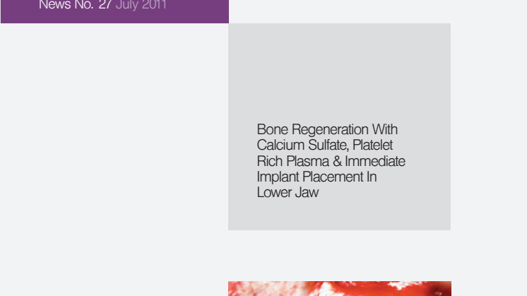Bone Regeneration With Calcium sulfate Platelet Rich Plasma & Immediate Implant Placement in Lower Jaw