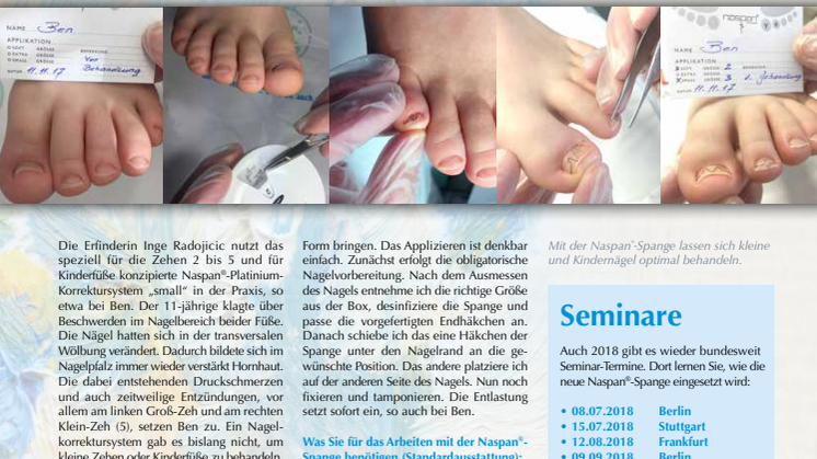 Naspan®-Platinium-Korrektursystem im Praxiseinsatz, Teil 2: Kinderfüße