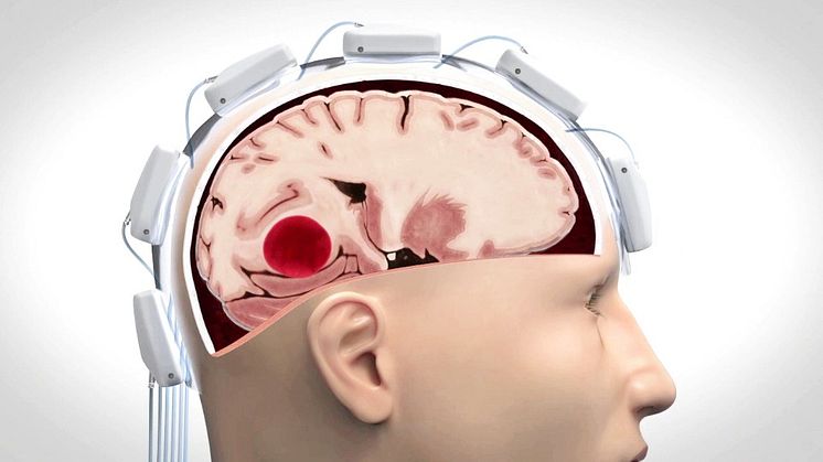Så skiljer Strokefinder hjärnblödning från blodpropp