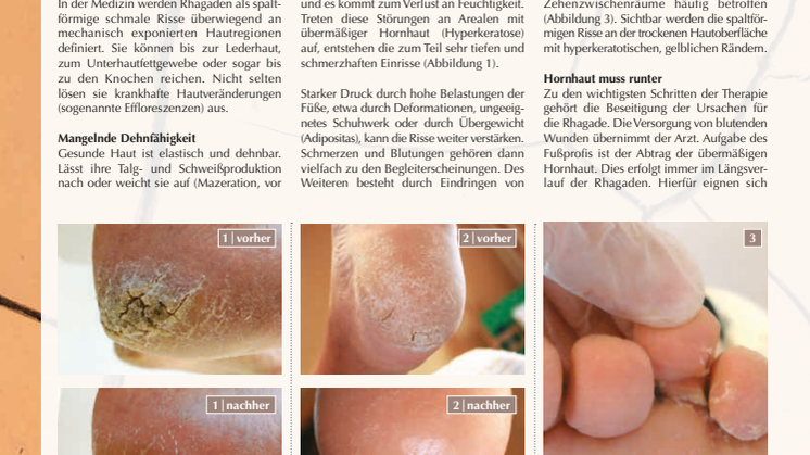 Rhagaden: Die gerissene Haut