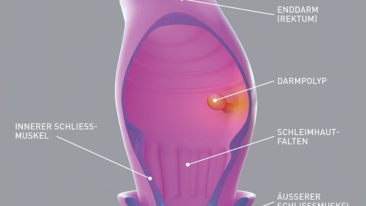 Anfangs ganz harmlos: Ein Darmpolyp