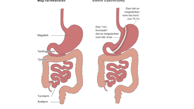 Fakta om sleeve gastrectomy