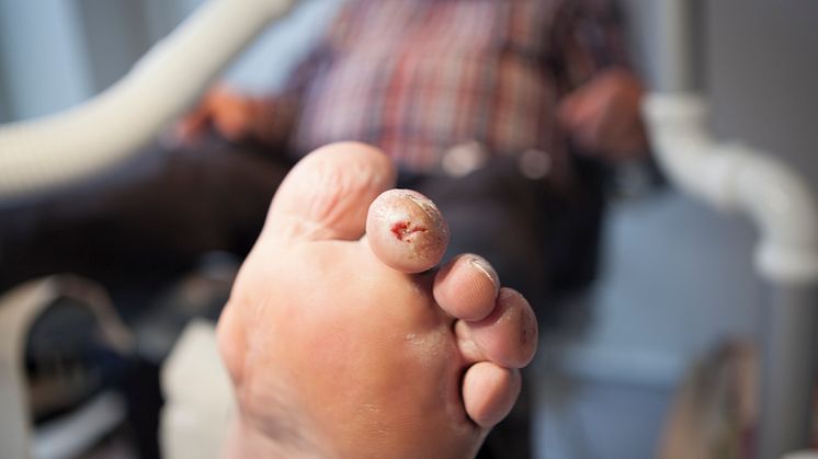 Et diabetisk fodsår kan se uskyldigt ud, men det kan resultere i amputation og er derfor et kritisk fodproblem. Foto: Mie Hampen