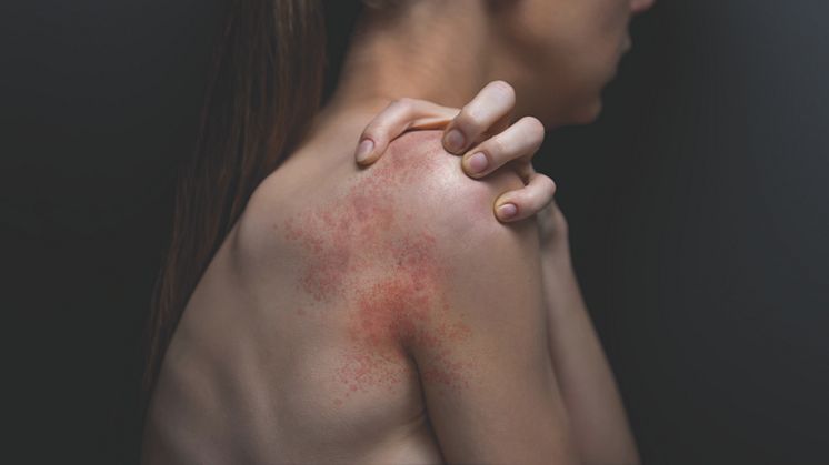 Almirall får EU-godkännande av EBGLYSS® (lebrikizumab) för behandling av måttlig till svår atopisk dermatit