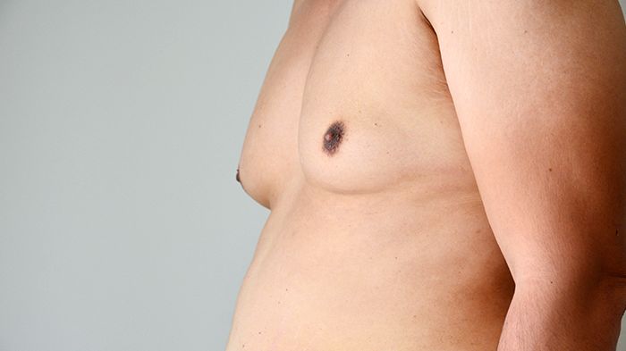 Man Boobs: A Real Problem That You Should Consider Surgery For?
