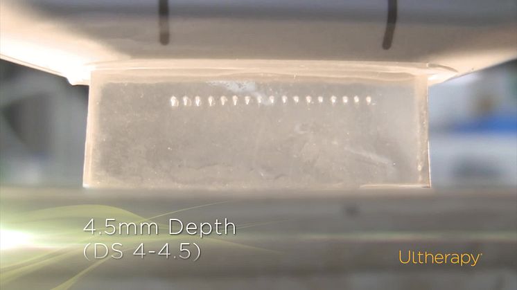 [Ultherapy] 3 Depths of Precise Energy Delivery