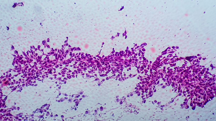 Första målinriktade behandlingen av icke-småcellig lungcancer med METex14-mutationer godkänd i Sverige