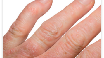 Omkring en tredjedel av alla som har psoriasis får även psoriasisartrit, en kronisk inflammatorisk sjukdom där en eller flera leder drabbas.