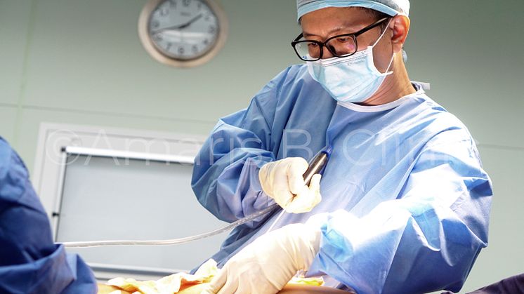 Dr. Ivan Puah is seen above performing a liposuction surgery on a male patient in Singapore, applying the MDC-Sculpt®️ Lipo technique.