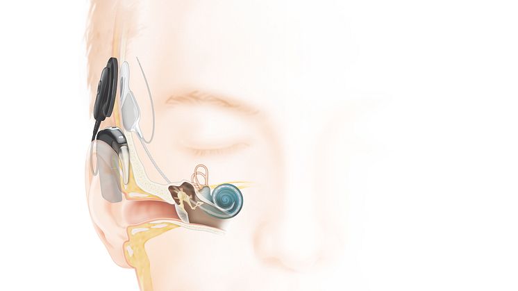 Wie das Hören mit einem Cochlea-Implantat (hinter dem Ohr) funktioniert
