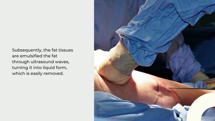 Vaser Lipo vs Laserlipolysis (Laser Lipo) Differences 