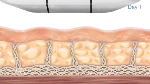 [Ultherapy] What Is Ultherapy?