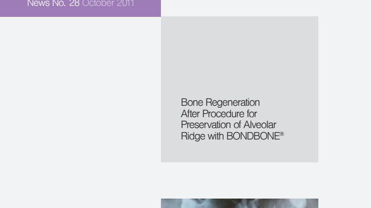 Bone Regeneration After Procedure For Preservation of Alveolar Ridge With BONDBONE®