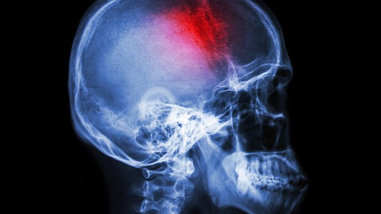  Thousands could benefit from revolutionary stroke treatment