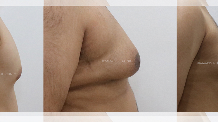 How do I know if I have Gynecomastia or Pseudogynecomastia?