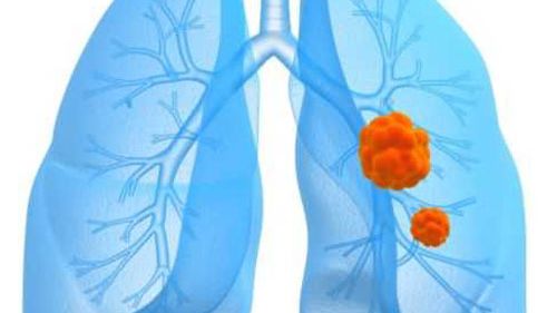 Ett nytt läkemedel förlänger överlevnaden för patienter med en viss typ av lungcancer