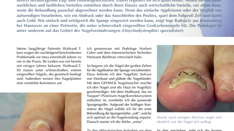 Naspan®-Platinium-Nagelkorrektursystem: "Ich habe wieder Lebensqualität"