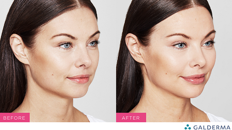 Before and After Restylane® Kysse by Galderma