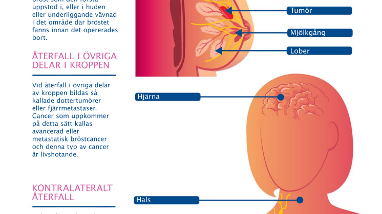 Återfall i bröstcancer - illustration