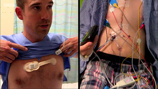 Isansys Lifecare's Wireless Patient Monitoring System Features on the BBC