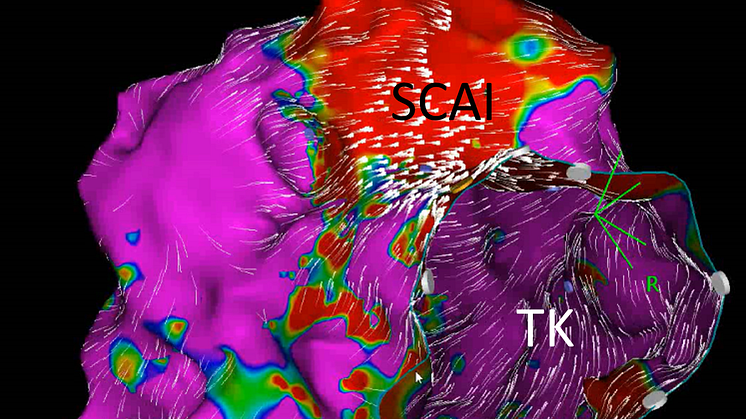 Elektroanatomische Karte (EAM) eines SCAI  