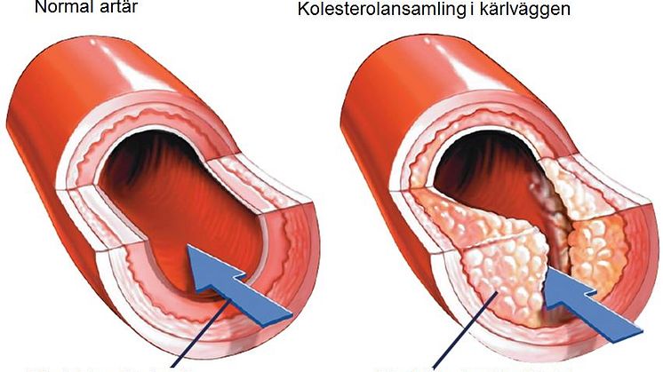 Ateroskleros är den viktigaste bakomliggande orsaken till hjärt-kärlsjukdomar som i sin tur är den vanligaste dödsorsaken i världen.
