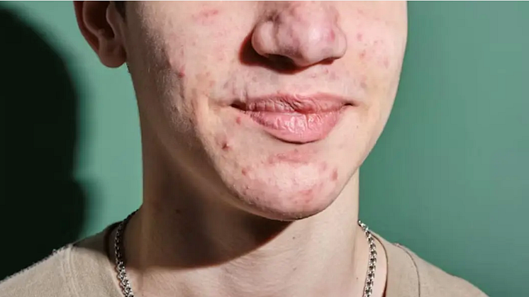 Treating Acne Vulgaris & Atrophic Acne Scars with Microneedling in Singapore