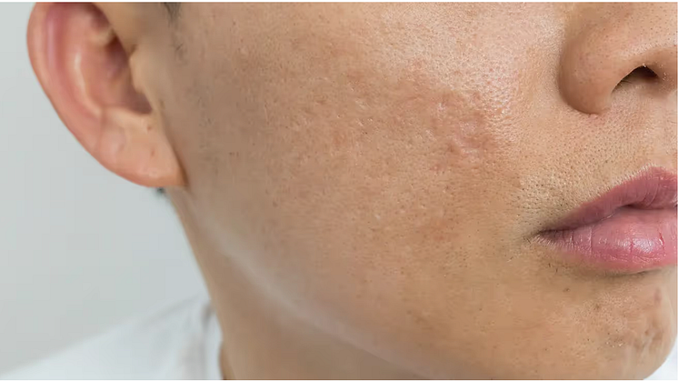 Type Of Skin Conditions Pico Fractional Laser Can Address | Acne, Large Pores, Hyperpigmentation