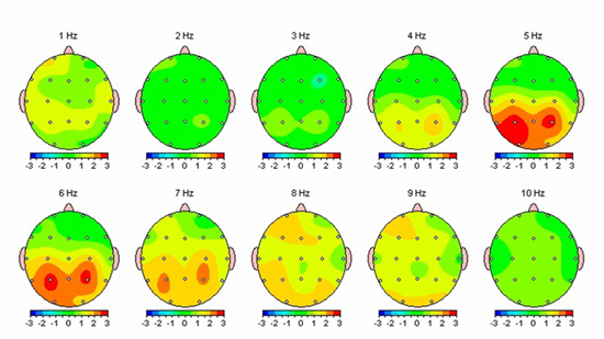   Neurofeedback: En effektiv behandling af depression